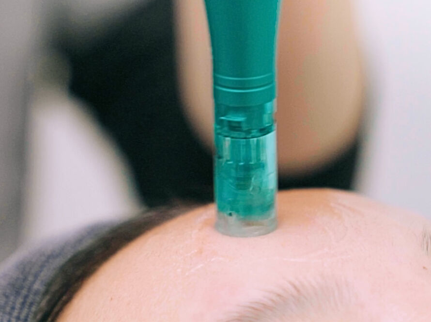 Microneedling (MTS) 1920x1080 Treatment Image