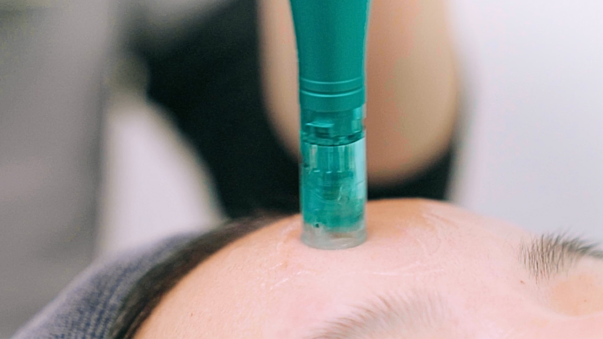 Customised Microneedling (MTS)