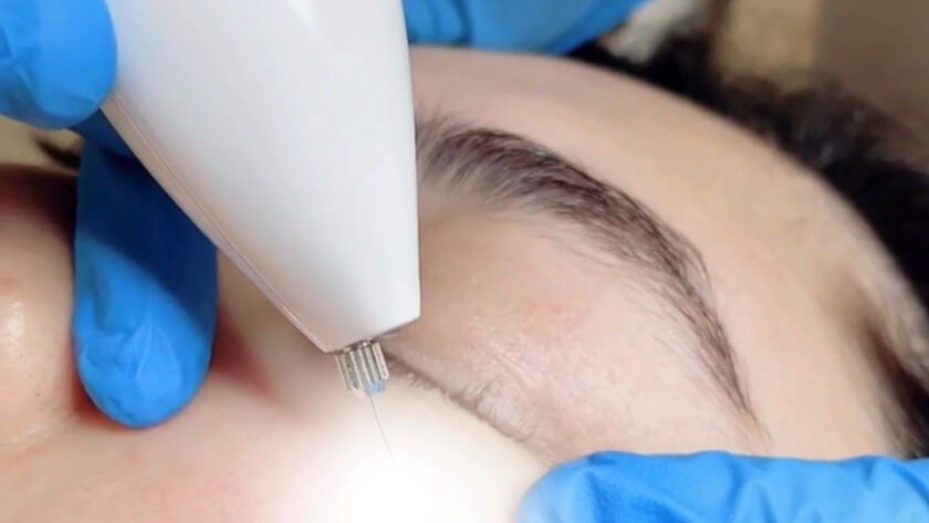 Milia Seed and Skin Tag Removal 1920x1080 Image