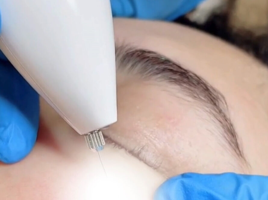 Milia Seed and Skin Tag Removal 1920x1080 Image