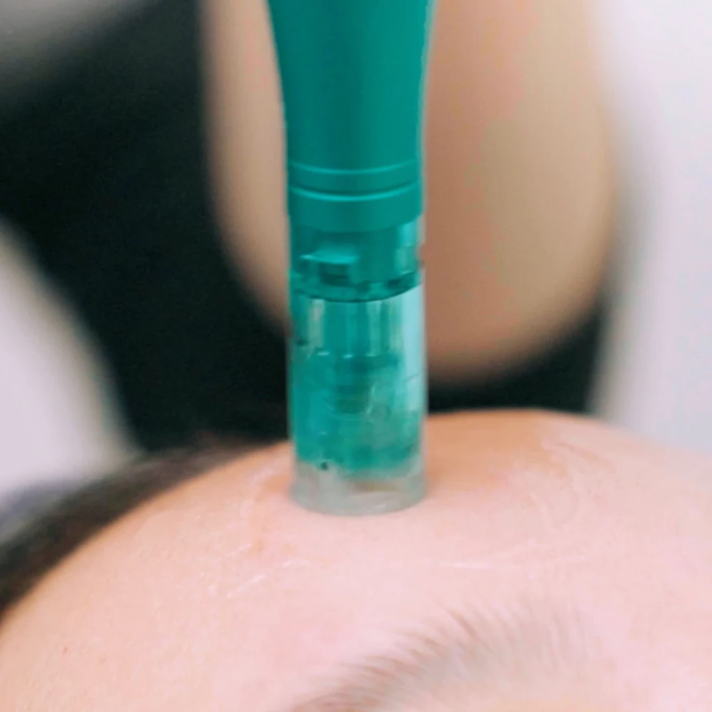 Treatment Customised Microneedling MTS 1080x1080 Image