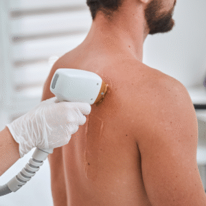 SHR Hair Removal (Full Back)