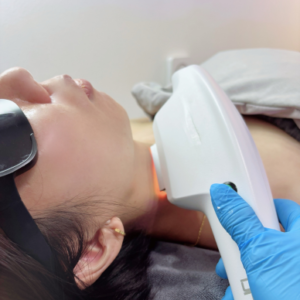 SHR Hair Removal (Neck）