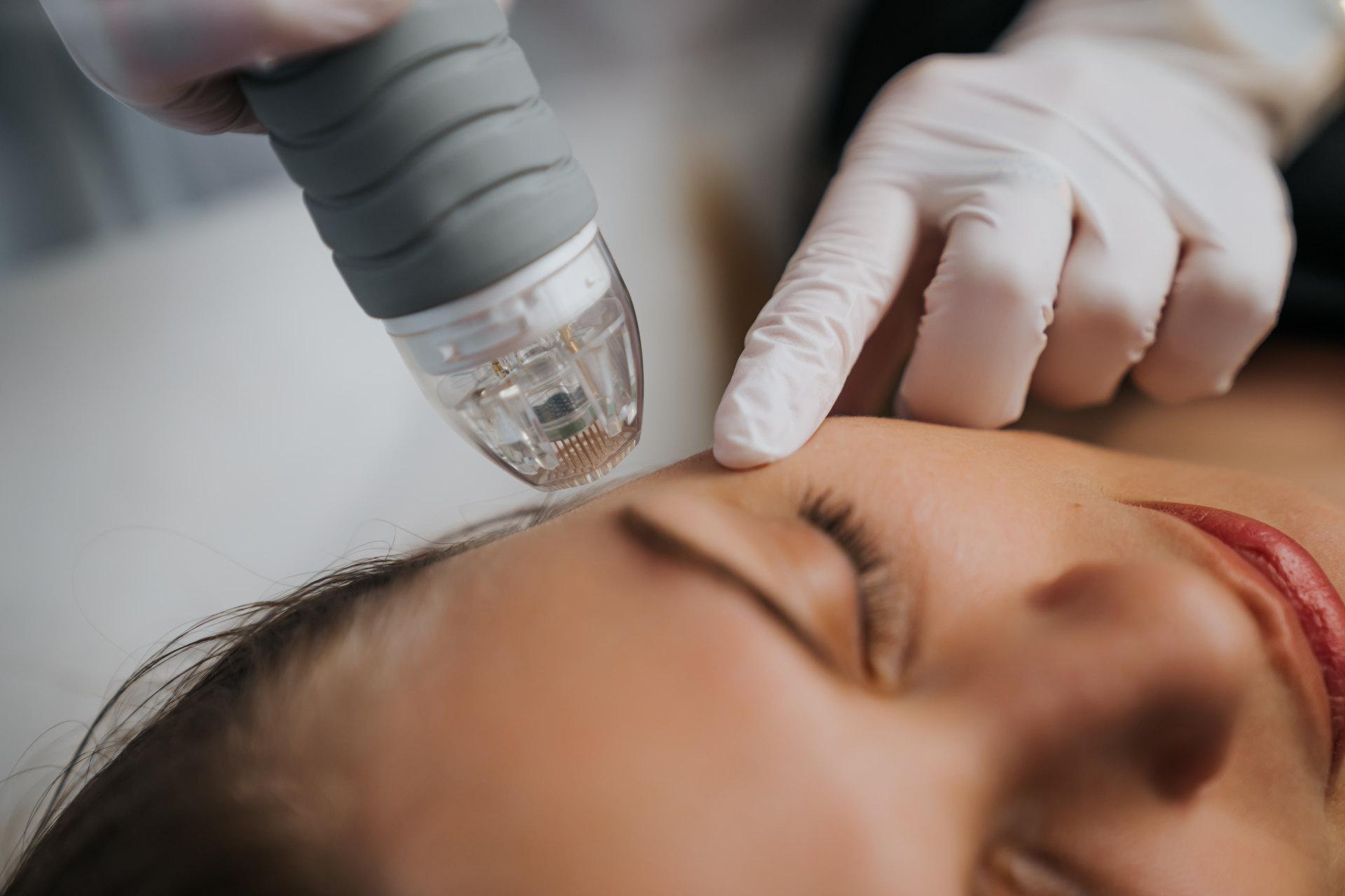 RF Microneedling vs Microneedling for Acne Scars: Which Should You Choose in Singapore?